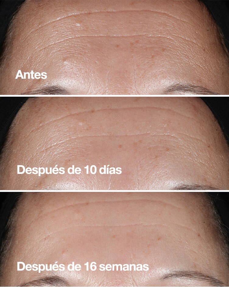 Before. After 12 weeks.*